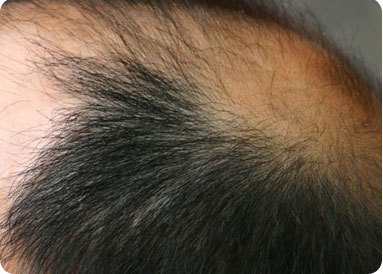 baldness02