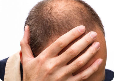 baldness01